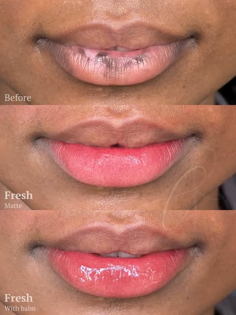 Lip macules are one of the most misunderstood things we see in lip work.

They are not the same as g