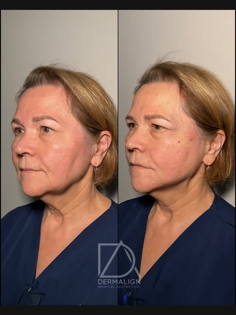 The profile says it all… 👀

PDO threads created the lift, while strategically placed fillers comple