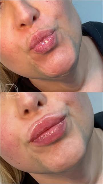 New lips. New confidence. 💋

A little refinement can change the whole vibe.

📍Langhorne, PA
📞215-