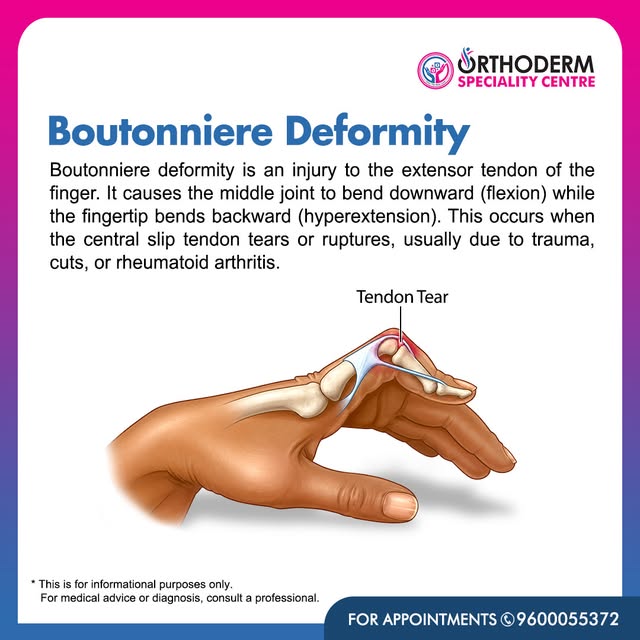 Boutonniere Deformity – When a Finger Tendon Injury Changes Finger Movement 🖐️

Boutonniere deformi