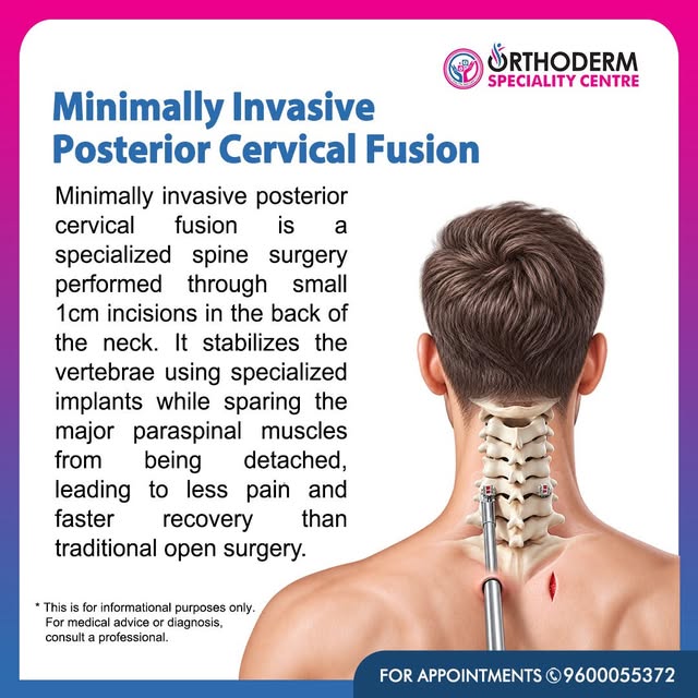 Minimally Invasive Posterior Cervical Fusion 🦴

Minimally invasive posterior cervical fusion is a s