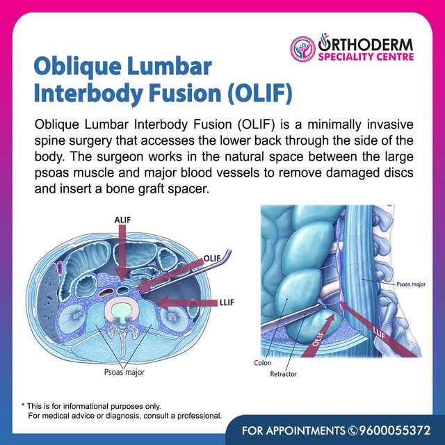 What is OLIF? 🦴

Oblique Lumbar Interbody Fusion (OLIF) is a minimally invasive spine surgery used 