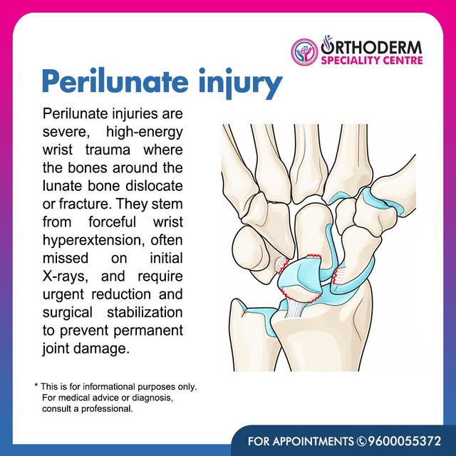 Perilunate Injury – A Serious Wrist Injury 🖐️⚠️

A perilunate injury is a severe wrist injury that 