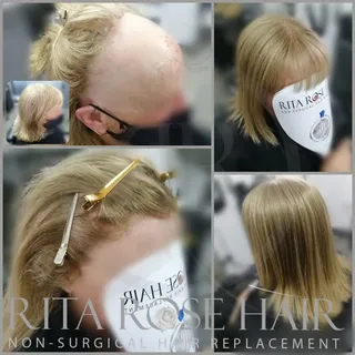 When my client started losing her hairline, she wore tape-in extensions to help. But as the hair los