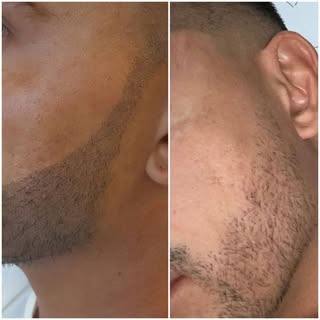 #alopecia#hairthinning#hairmicropigmentation#micropigmentation#thinninghair#thinninghaironwomen#scal