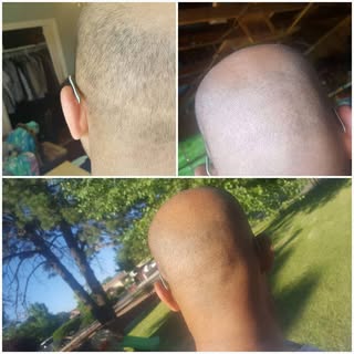 #alopecia#hairthinning#hairmicropigmentation#micropigmentation#thinninghair#thinninghaironwomen#scal