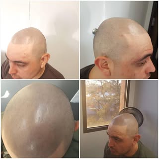 #scalpmicropigmentation