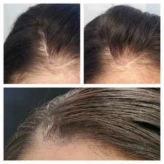 Scar Correction
