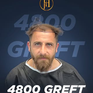 It’s time to restore your hair with natural-looking hair transplant solutions! Regain your confidenc