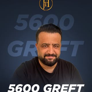 2 years after a 5,600 graft hair transplant.
A transformation built on careful planning, patience, a