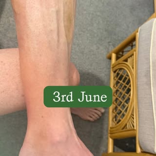 Ian’s recovery has been incredible to follow 🙌
Ian ruptured his Achilles playing tennis on 16th May
