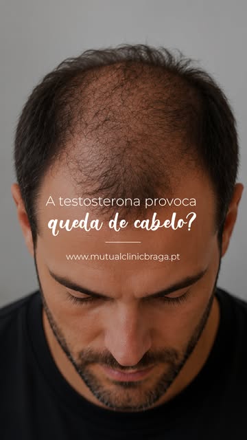 Testosterona e queda de cabelo: um dos temas que mais gera dúvidas. Afinal, o problema está na testo