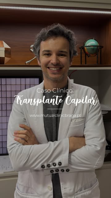 Está a ponderar realizar um transplante capilar, mas tem receio? Neste Reel mostramos o excelente re
