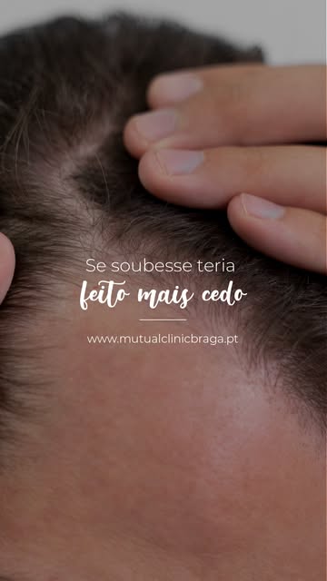 Muitas pessoas passam anos a adiar o transplante capilar por receio da dor, sem saberem como é realm