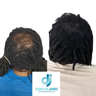 What a difference a density treatment can make! 

Duncan James SMP Clinic

www.duncanjamessmpclinic.