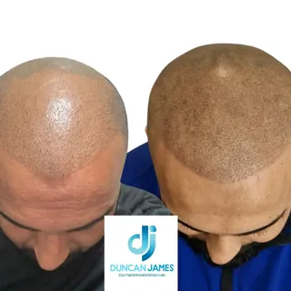 This client had a hair transplant, which had left scarring and some previous density work done by an