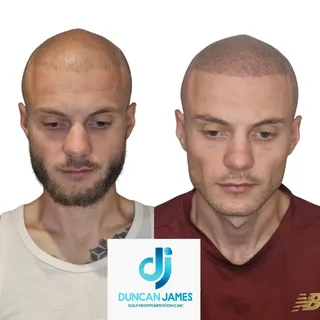 This client had a hair transplant but wasn't happy with the results.  We were able to bring a fuller
