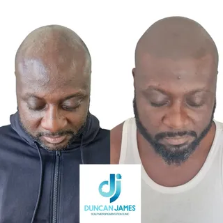 Hairline coming back like it never left!! 

Duncan James SMP Clinic
www.duncanjamessmpclinic.com
T