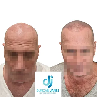 These images of the client were taken after the first and last session. 
The first session is our ba