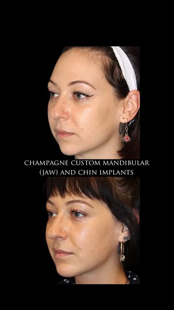 A strong mandibular border (aka jawline) isn’t created by the body of the mandible alone.
When I eva