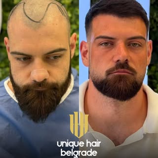 Stefan Stević | 4,5 meseca nakon transplantacije kose 🫡

Pre 4,5 meseca u Unique Hair Clinic obavil