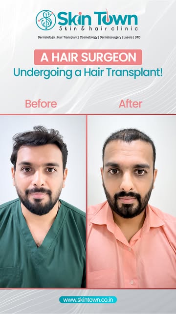 Even hair transplant surgeons deal with hair loss.

I’m Dr. Bhushan Bawankar, documenting my hair tr