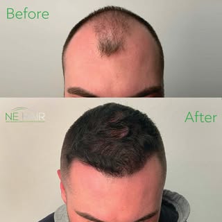 Incredible before and after from our microFUE™️⁠ Hair Transplant⁠. ⁠See yesterday's post for Jason's
