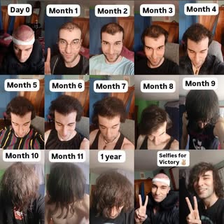 Hair Transplant Growth Through the Year⁠
⁠
⁠
⁠
"I can not tell you how GOOD I feel at this moment! T