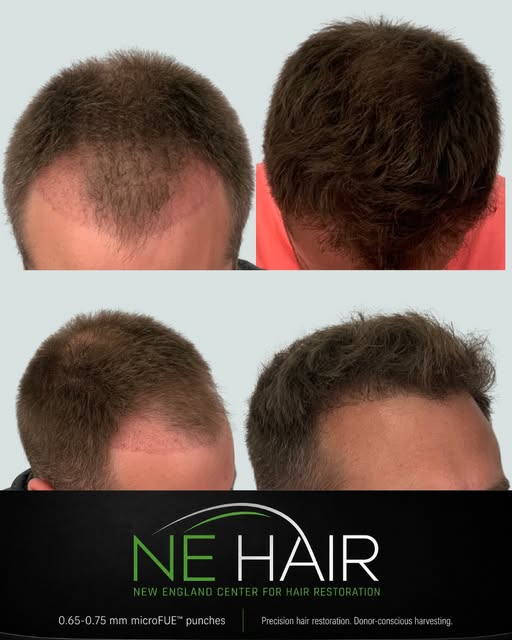 ⚡️ Around 2,000 Grafts | See Both Sides of the Result

A hair transplant result has two sides: what 