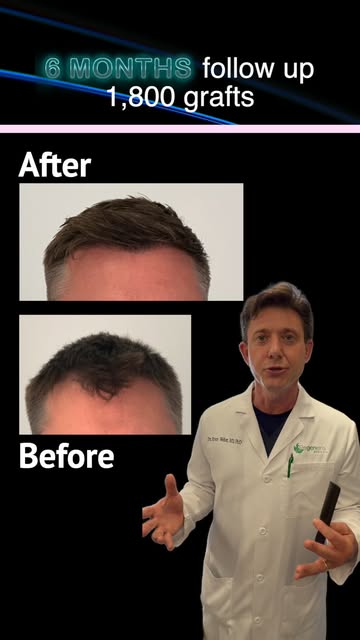 ⚡️ 1,800 Grafts | Sometimes Subtle Makes a Big Difference

Not every hair transplant needs thousands