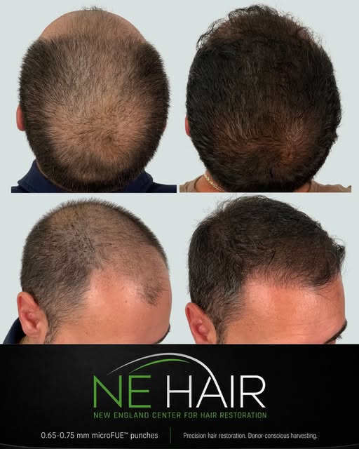 ⚡️ 2,000 Grafts | Only 6 Months

Sometimes a carefully planned number of grafts can go a very long w