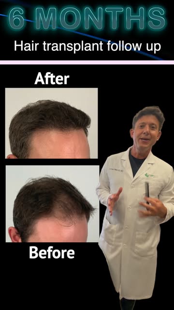 6 Months | 3,000 Grafts ⚡️

A hair transplant should not only be judged by the hair you add. You sho