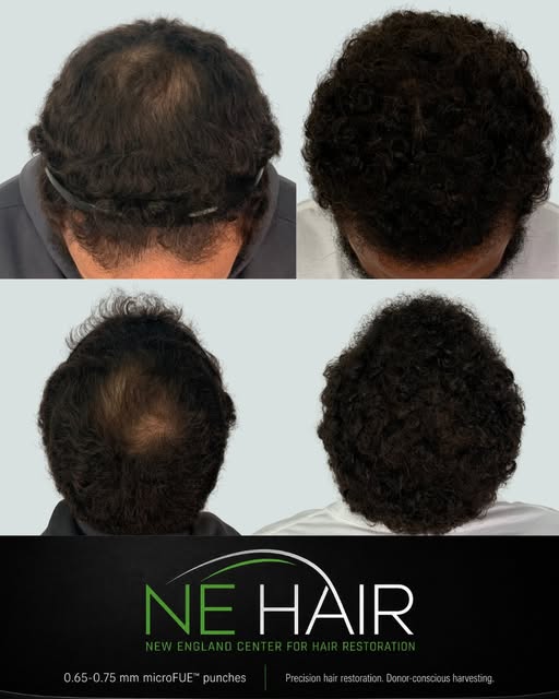 ⚡️ Around 3,000 Grafts | 6-Month Follow-Up

What a difference six months can make.

This patient cam