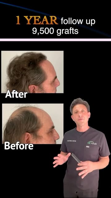 9,500 Grafts Across Multiple Procedures | 1 Year ⚡️

This transformation has been years in the makin