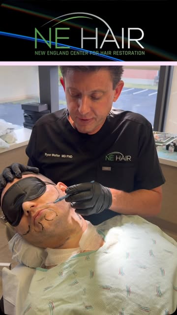 🧔 2,500 Grafts | Beard Restoration

Hair restoration isn’t limited to the scalp.

In today’s video,