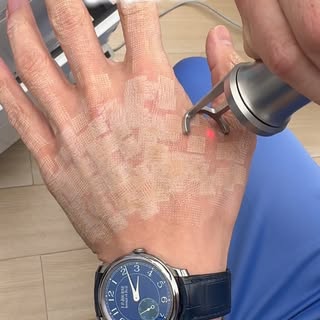 Dermablate’s latest DeepSpot Handpiece has amazing “Warm” & “Cold” Fractionated Ablative Laser combo