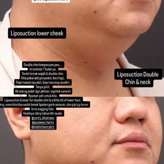 7 months post Liposuction + laser (Lipolase), lemak yg terkumpul di pipi bawah dan double chin sudah