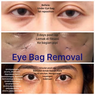 Blepharoplasty 
Jika mau hilangkan/ operasi kantong mata dengan down time & penyembuhan yang agak ce