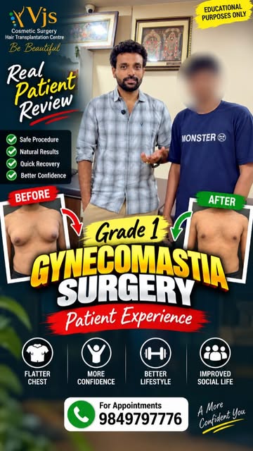 Grade 1 Gynecomastia Surgery — Real Patient Experience 💪✨

In this Reel, the patient shares his exp