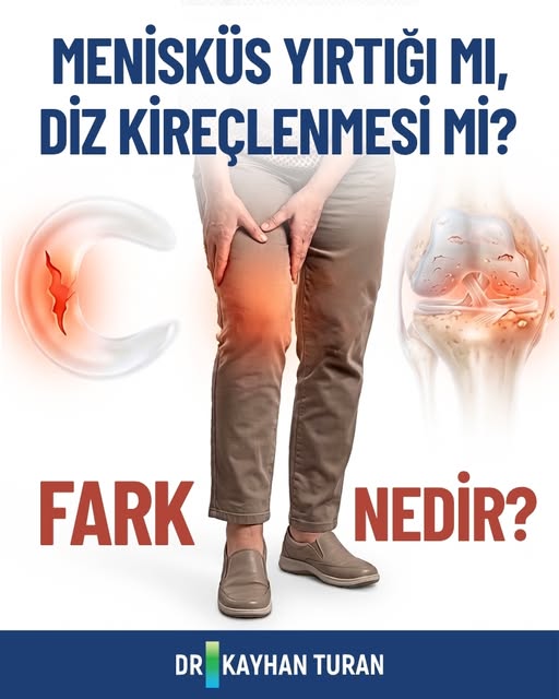 Menisküs yırtığı mı, diz kireçlenmesi mi? İkisi de diz ağrısı yapar, ama kaynakları farklıdır. 🦵

K