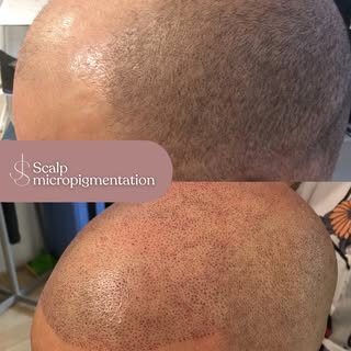 A receding hairline is one of the most common concerns I see, and one that affects confidence far mo