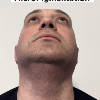 Is your beard patchy or uneven?

Beard Micropigmentation can create the appearance of greater densit