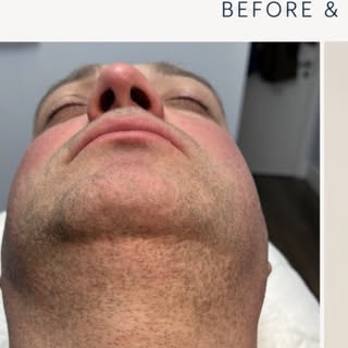 Struggling with a patchy beard?

See how Beard Micropigmentation can enhance your beard’s appearance