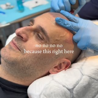 This right here… 10/10. 🔥

Scalp micropigmentation — tiny pigment deposits that replicate the look 