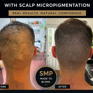FUE scars don’t have to be the part of your hair transplant story that you hide.

Using Scalp Microp