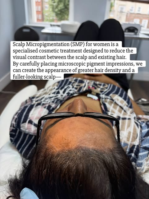 A natural-looking transformation ✨

Female hair-density SMP can help reduce scalp show-through and c