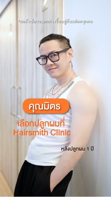 ครั้งนี้คุณมิตรเลือก Hairsmith Clinic #ปลูกผม #รีวิวปลูกผม #ผมบาง #hairtransplant #haircare