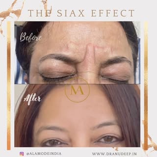 BOTOX/SIAX

Botox is a muscle relaxer. It employs botulinum toxin type A, to temporarily control a m