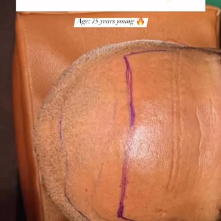 'I know age is just a number but hairline matters' 😉
- My 75 year old Hair transplant patient