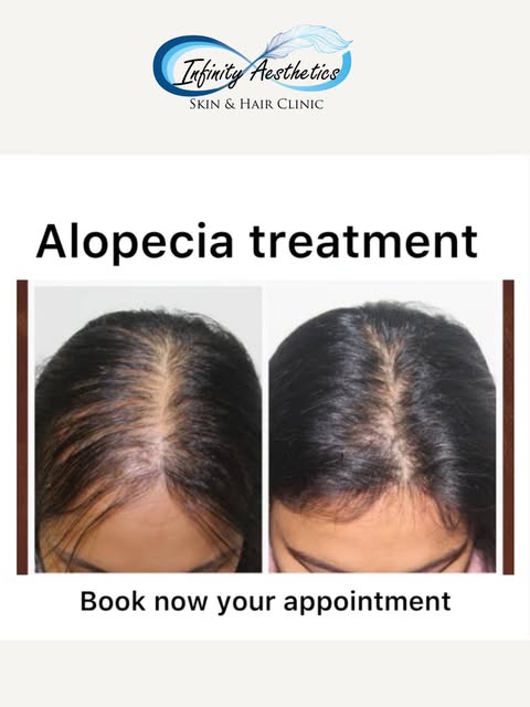 ✨ Alopecia Treatment | Regain Your Confidence ✨

Hair loss can be stressful, but the right treatment